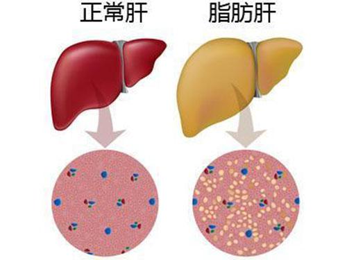 脂肪肝怎么调理（脂肪肝怎么调理最好最快）