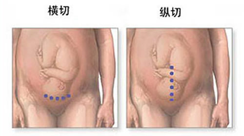 剖腹产横切还是竖切好