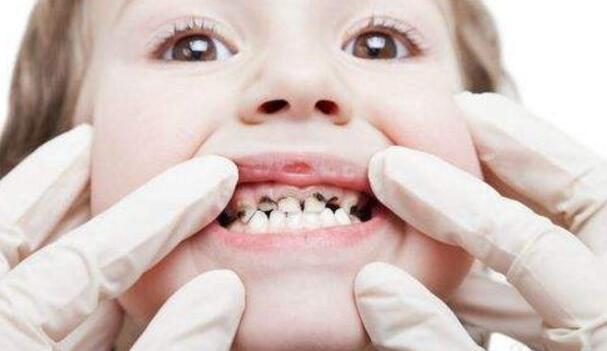 如何保护牙齿预防蛀牙 如何保护牙齿预防蛀牙教案