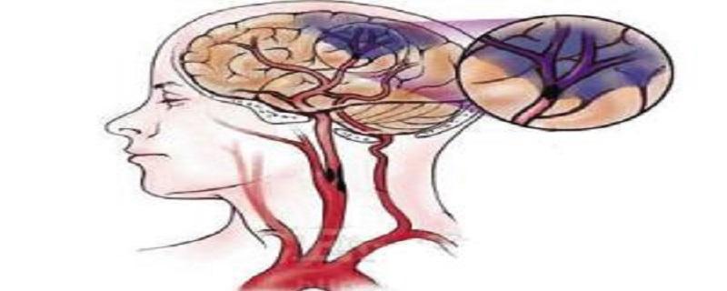 脑梗死是什么病（急性脑梗死是什么病）