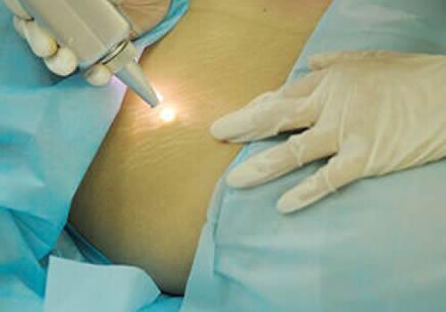 剖腹产后妊娠纹怎么消除 生完孩子肚子妊娠纹怎么消除
