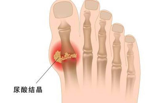 尿酸不高会不会得痛风 痛风一定是尿酸高吗