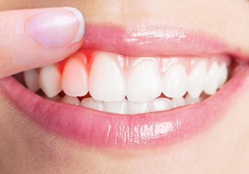洗牙牙齿会变白吗 洗牙的牙齿会变白吗