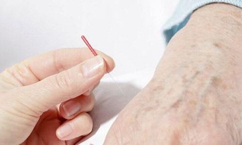 针灸可以治荨麻疹吗 针灸可以治荨麻疹吗?