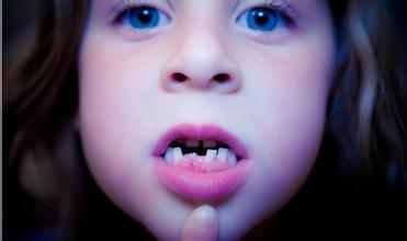 儿童换牙期注意事项（换牙期注意事项）