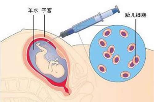 羊水穿刺什么时候做 高龄羊水穿刺什么时候做