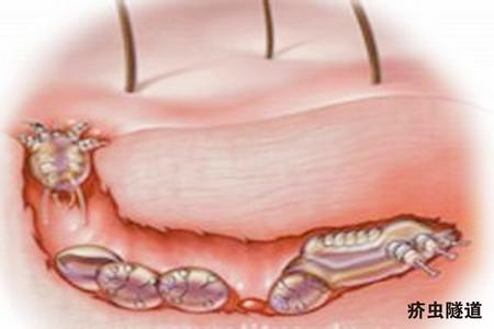 疥疮是怎么引起的 女性疥疮是怎么引起的