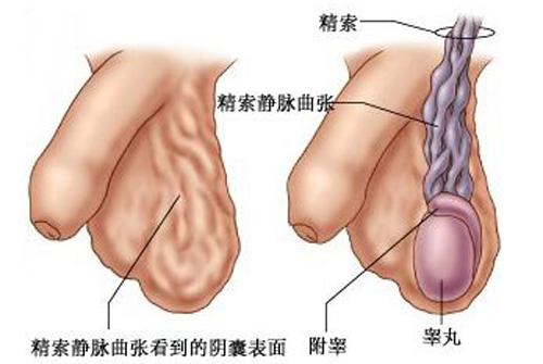 睾丸静脉曲张会疼吗 静脉曲张会导致睾丸痛吗