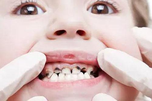 蛀牙的影响 蛀牙带来的危害