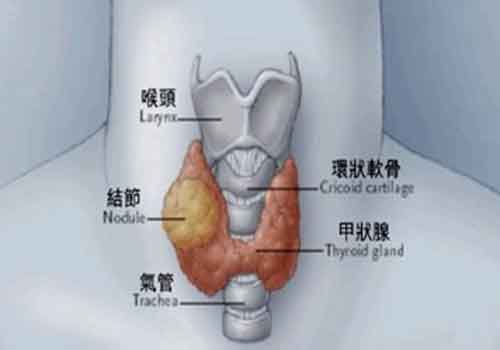 甲状腺结节能治愈吗（中医治甲状腺结节能治愈吗）