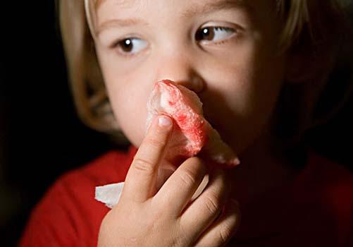 小孩流鼻血是什么原因 小孩流鼻血是什么原因怎样处理