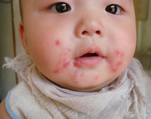 儿童为何易患脓疱疮 儿童脓疱疹是由于什么原因引起