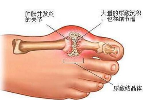 痛风用什么泡脚最好（有痛风的用什么泡脚更好）