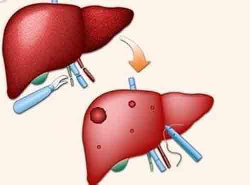肝癌的晚期症状 肝癌的晚期症状表现
