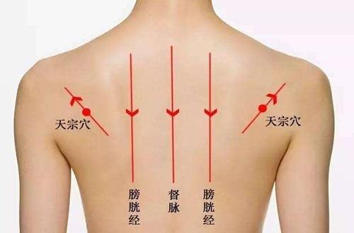 拔罐后背的位置示意图（后背拔罐图示意图）