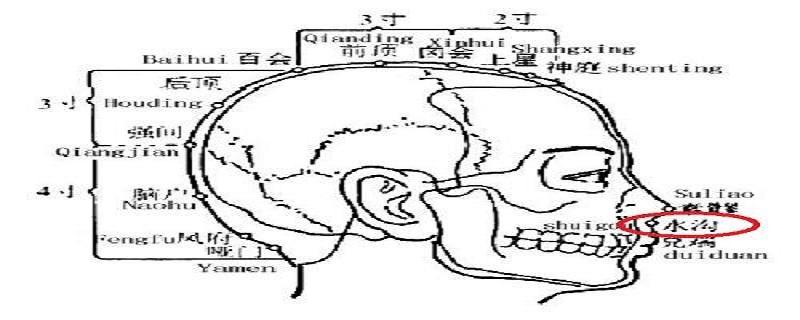 水沟的针刺方法 针灸水沟的操作方法