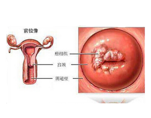 hpv病毒是什么 hpv病毒是什么病