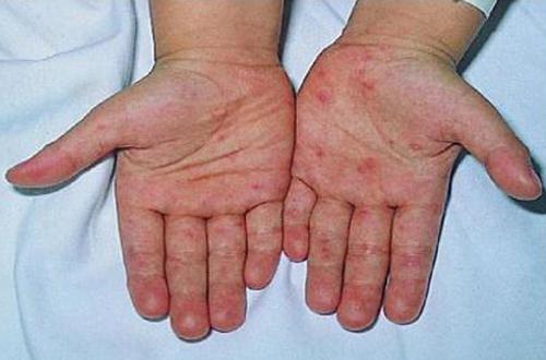 手足口病初期症状（手足口病初期症状有哪些）