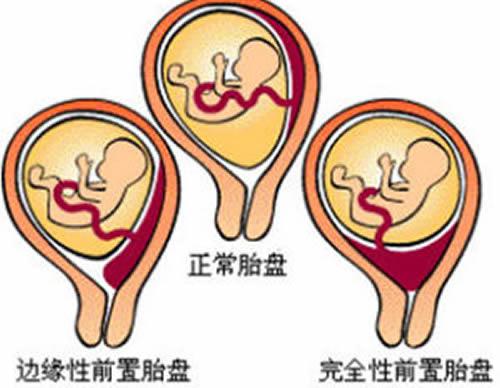 前置胎盘是怎样造成的 前置胎盘是怎么造成的