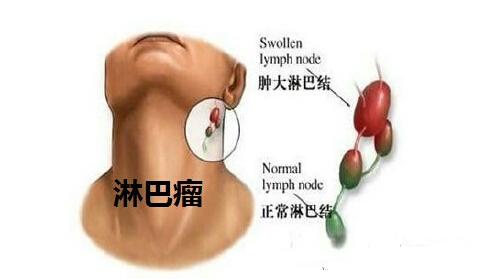 肺癌究竟是如何转移的 转移到肺的癌是肺癌吗