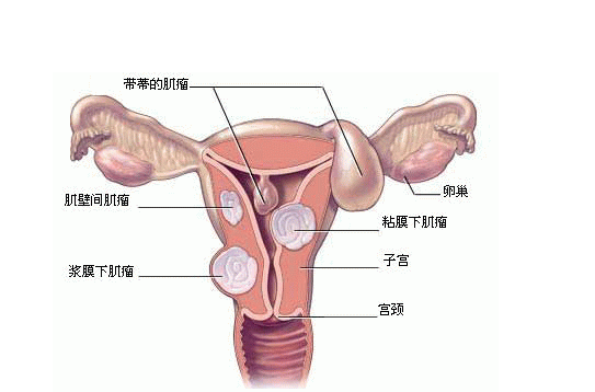 子宫肌瘤常见并发症（子宫肌瘤最常见的并发症有哪些）