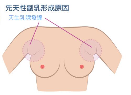 副乳的危害 副乳的危害有多大