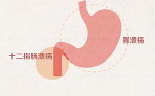 胃溃疡症状表现有哪些 胃溃疡饮食注意事项