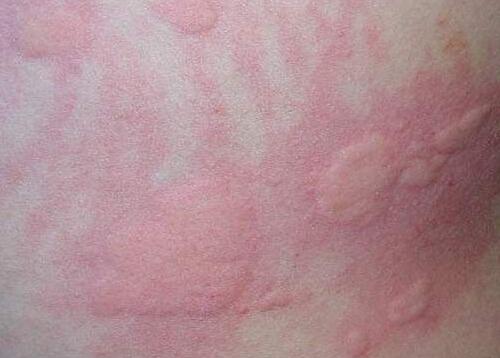 秋季荨麻疹会不会传染 秋季荨麻疹症状是什么?会传染吗?