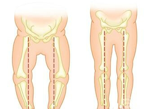 婴儿O型腿如何判断 婴儿o型腿怎么判断