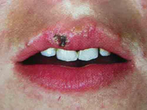口唇疱疹是什么引起的（口唇疱疹是什么引起的?）