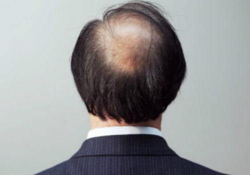 什么是脂溢性脱发（什么是脂溢性脱发男性）