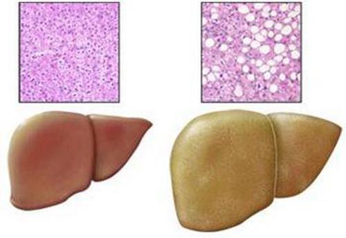 脂肪肝的危害及防治 脂肪肝有什么危害怎么治疗