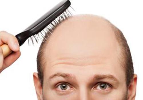 男性脱发是什么原因引起的 年轻男性脱发是什么原因引起的