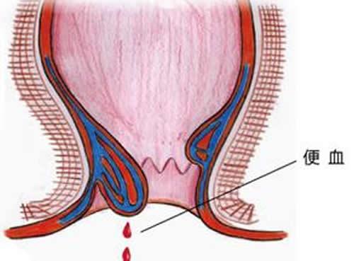 产后便血怎么回事（产后老是便血怎么办）