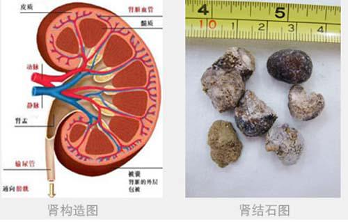 肾结石需要做手术吗 肾结石需要做手术吗?