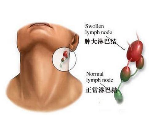 淋巴瘤四大临床表现是神马（淋巴瘤最典型症状）