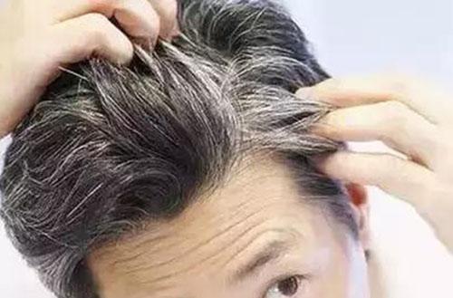 白发怎么治 治疗白头发最佳方法