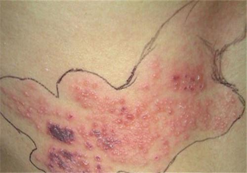 带状疱疹传染途径 带状疱疹传染途径带状疱疹会不会传染