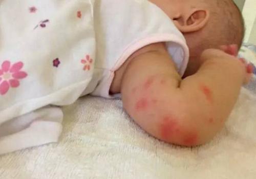 宝宝被蚊子叮了有疤自己会消吗（宝宝被蚊子咬了有疤）
