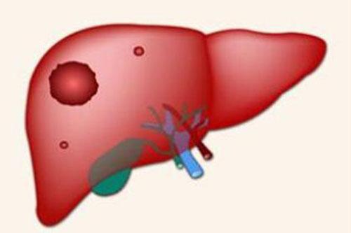 肝癌有哪些典型的症状 肝癌的主要症状有哪些