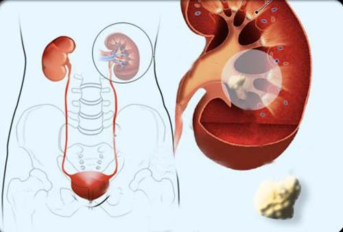 肾结石饮食注意事项 肾结石要注意