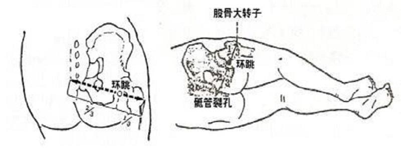 环跳的准确位置图视频 环跳位置图片