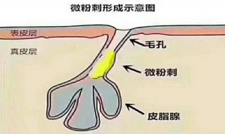 如何有效应对毛孔堵塞（怎么样才能解决毛孔堵塞）