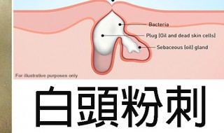 脸上长粉刺是什么原因怎样去掉 脸上长粉刺是什么原因怎样去掉呢