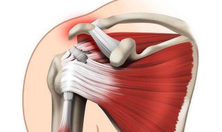 肌肉拉伤怎么快速恢复 肌肉拉伤怎么快速恢复腹部