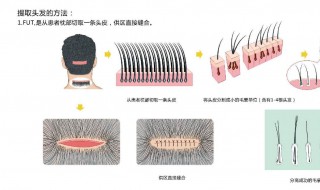 植头发原理 头发植发原理