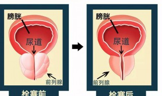 前列腺是什么 前列腺是什么原因引起的