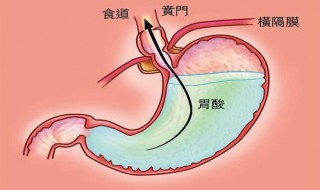 有点胃酸怎么办 有点胃酸怎么办快速缓解