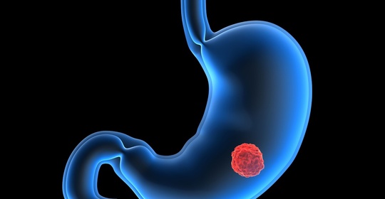 23岁姑娘胃疼2周没重视确诊胃癌，身上有这5大特质，胃癌风险剧增