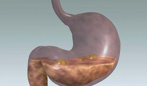 胃炎是怎么引起的 反流性胃炎是怎么引起的